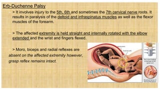 Erb-Duchenne Palsy
– > It involves injury to the 5th, 6th and sometimes the 7th cervical nerve roots. It
results in paralysis of the deltoid and infraspinatus muscles as well as the flexor
muscles of the forearm.
– > The affected extremity is held straight and internally rotated with the elbow
extended and the wrist and fingers flexed.
– > Moro, biceps and radial reflexes are
absent on the affected extremity however,
grasp reflex remains intact.
 
