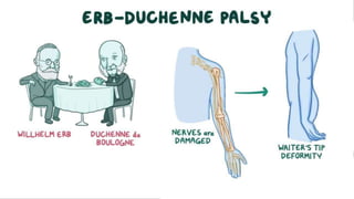 Erb-Duchenne Palsy
 
