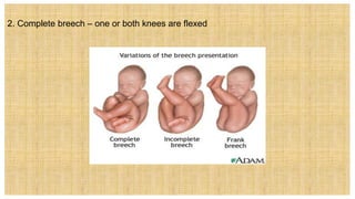 2. Complete breech – one or both knees are flexed
 