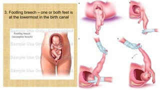 3. Footling breech – one or both feet is
at the lowermost in the birth canal
 