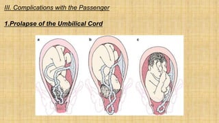 III. Complications with the Passenger
1.Prolapse of the Umbilical Cord
 