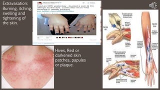 Burning, itching,
swelling and
tightening of
the skin.
Extravasation:
Hives, Red or
darkened skin
patches, papules
or plaque.
 