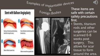 These items are
safe with certain
safety precautions
first.
• Stents, titanium
rods and other
surgeries can be
scanned 6-8
weeks post
surgery. This
allows for scar
tissue to form
around the area.
 