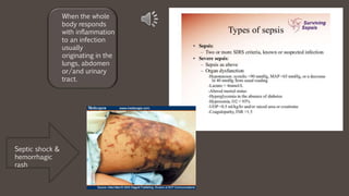When the whole
body responds
with inflammation
to an infection
usually
originating in the
lungs, abdomen
or/and urinary
tract.
Septic shock &
hemorrhagic
rash
 