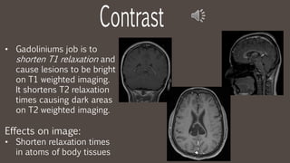 • Gadoliniums job is to
shorten T1 relaxation and
cause lesions to be bright
on T1 weighted imaging.
It shortens T2 relaxation
times causing dark areas
on T2 weighted imaging.
Effects on image:
• Shorten relaxation times
in atoms of body tissues
 