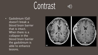 • Gadolinium (Gd)
doesn’t break a
blood brain barrier
that is intact.
When there is a
collapse in the
blood brain barrier
the gadolinium is
able to enhance
lesions.
 