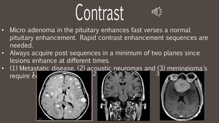 • Micro adenoma in the pituitary enhances fast verses a normal
pituitary enhancement. Rapid contrast enhancement sequences are
needed.
• Always acquire post sequences in a minimum of two planes since
lesions enhance at different times.
• (1) Metastatic disease, (2) acoustic neuromas and (3) meningioma's
require contrast injection. 21 3
 