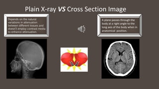 Plain X-ray VS Cross Section Image
D
Depends on the natural
variations in attenuation
between different tissues and
doesn’t employ contrast media
to enhance attenuation.
A plane passes through the
body at a right angle to the
long axis of the body when in
anatomical position.
 