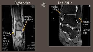 Left AnkleRight Ankle
medial
malleolu
s Fibula
is on
the
lateral
side
R L
medial
malleolu
s
Fibula
is on
the
lateral
side
 
