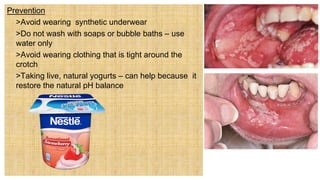 Prevention
 >Avoid wearing synthetic underwear
 >Do not wash with soaps or bubble baths – use
water only
 >Avoid wearing clothing that is tight around the
crotch
 >Taking live, natural yogurts – can help because it
restore the natural pH balance
 