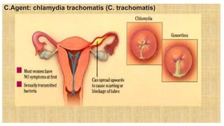 C.Agent: chlamydia trachomatis (C. trachomatis)
 