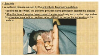 c. Syphylis
> A systemic disease caused by the spirochete Treponema pallidum
 * Before the 18th week, the placenta provides some protection against the disease
 * After this time, the spirochete crossed the placenta freely and may be responsible
for spontaneous abortion, pre term labor, stillbirth or congenital anomalies of the
newborn
 