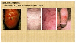 Signs and Symptoms:
 Painless ulcer (chancre) on the vulva or vagina
 