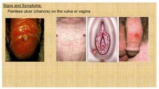 Signs and Symptoms:
 Painless ulcer (chancre) on the vulva or vagina
 