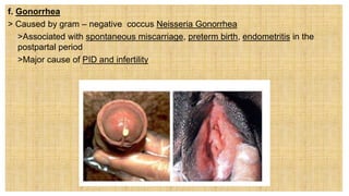 f. Gonorrhea
> Caused by gram – negative coccus Neisseria Gonorrhea
 >Associated with spontaneous miscarriage, preterm birth, endometritis in the
postpartal period
 >Major cause of PID and infertility
 
