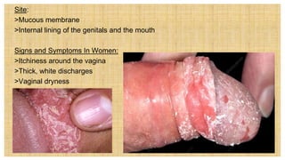 Site:
 >Mucous membrane
 >Internal lining of the genitals and the mouth
Signs and Symptoms In Women:
 >Itchiness around the vagina
 >Thick, white discharges
 >Vaginal dryness
 