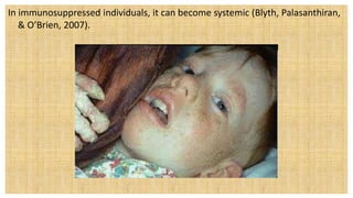 In immunosuppressed individuals, it can become systemic (Blyth, Palasanthiran,
& O’Brien, 2007).
 