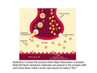 Illustration 2 shows the process when Major Depression is present.
Note that fewer Serotonin molecules are present in the synaptic cleft
and hence fewer make it to the next neuron to make it "fire."

 