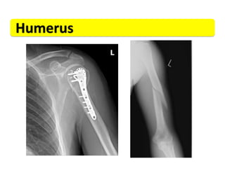Humerus	
  
 
