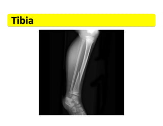 Tibia	
  
 