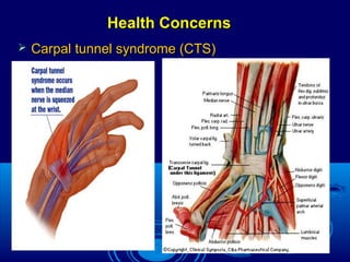 Health ConcernsHealth Concerns
 Carpal tunnel syndrome (CTS)Carpal tunnel syndrome (CTS)
 