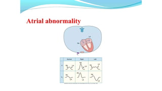 Week 17 Abnormal ECG Interpretation.pptx