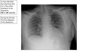 51 Year-Old With
Burning Chest Pain
For 1 Hour After
Getting In To An
Argument.
HR 57, BP 196/100
During His ED Stay
The Pain Migrates
To His Abdomen…
 