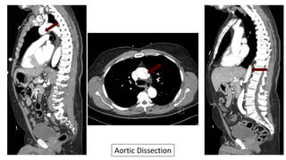 Aortic Dissection
 