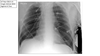 67 Year-Old In A
Single Vehicle MVC
Against A Tree
 