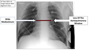 67 Year-Old In A
Single Vehicle MVC
Against A Tree
Wide
Mediastinum
Loss Of The
Aortopulmonary
Window
 