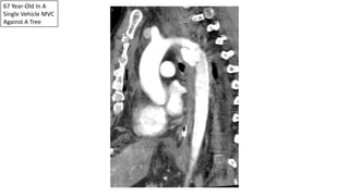 67 Year-Old In A
Single Vehicle MVC
Against A Tree
 