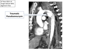67 Year-Old In A
Single Vehicle MVC
Against A Tree
Traumatic
Pseudoaneurysm
 