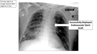 67 Year-Old In A
Single Vehicle MVC
Against A Tree
Successfully Deployed
Endovascular Stent
Graft
 