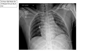 33 Year-Old Male On
A Moped Struck By A
Car
 