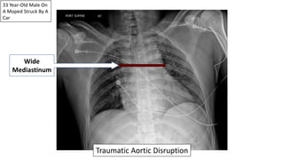 33 Year-Old Male On
A Moped Struck By A
Car
Wide
Mediastinum
Traumatic Aortic Disruption
 