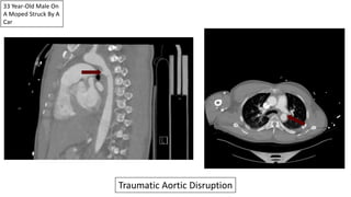 33 Year-Old Male On
A Moped Struck By A
Car
Traumatic Aortic Disruption
 