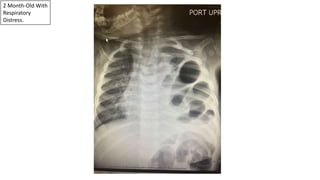 2 Month-Old With
Respiratory
Distress.
 