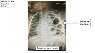 2 Month-Old With
Respiratory
Distress.
Diaphragmatic Hernia
Bowel In
The Chest
 