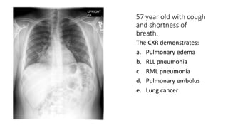 57 year old with cough
and shortness of
breath.
The CXR demonstrates:
a. Pulmonary edema
b. RLL pneumonia
c. RML pneumonia
d. Pulmonary embolus
e. Lung cancer
 