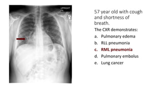 57 year old with cough
and shortness of
breath.
The CXR demonstrates:
a. Pulmonary edema
b. RLL pneumonia
c. RML pneumonia
d. Pulmonary embolus
e. Lung cancer
 