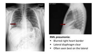 RML pneumonia:
 Blurred right heart border
 Lateral diaphragm clear
 Often seen best on the lateral
 