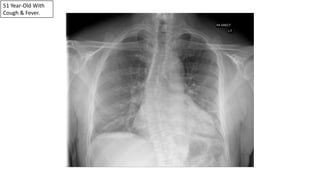 51 Year-Old With
Cough & Fever.
 