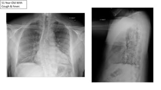 51 Year-Old With
Cough & Fever.
 