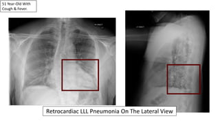 51 Year-Old With
Cough & Fever.
Retrocardiac LLL Pneumonia On The Lateral View
 