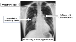 What Do You See?
Pulmonary Arterial Hypertension
Enlarged Right
Pulmonary Artery
Enlarged Left
Pulmonary Artery
 
