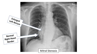 Mitral Stenosis
 