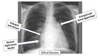 Mitral Stenosis
 