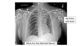 What Are You Worried About?
No Pulse
Left Arm!
 