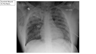 Gunshot Wound
To The Neck…
 