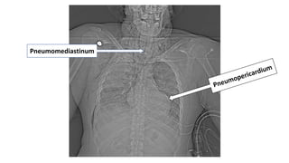 Pneumomediastinum
 